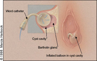 Office Management of Bartholin Gland Cysts and Abscesses