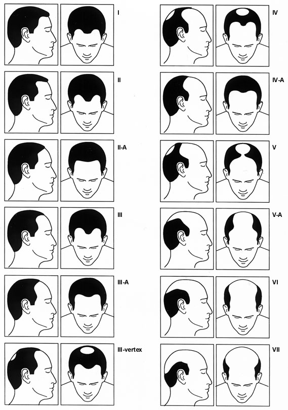 Medical Treatments for Balding in Men | AAFP