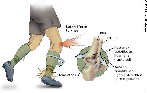 Ankle Ligament Injury - OrthoWashington
