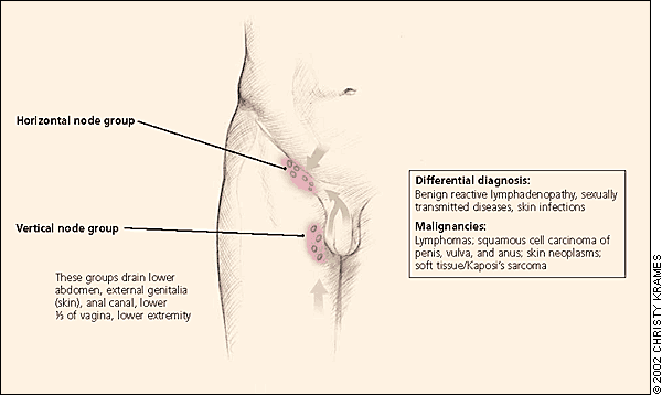 enlarged right epitrochlear lymph node