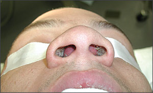 inflamed nasal turbinates