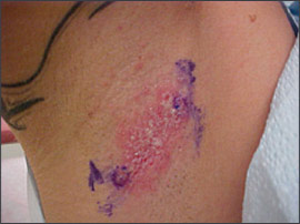 Woman with rash in groin