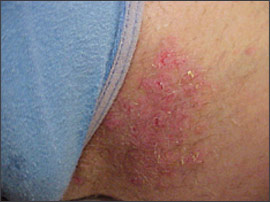 Heat Rash on Groin: Causes, Symptoms, Treatment