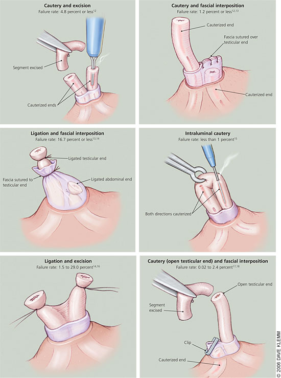 Vasectomy & Vasectomy Reversal