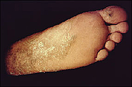 Tinea pedis and Tinea unguium caused by Trichophyton rubrum in an