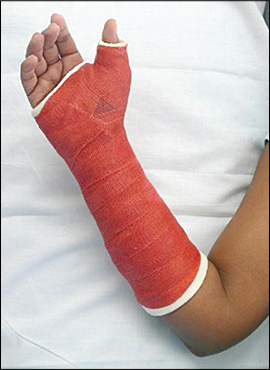 short arm cast  Arm cast, Broken arm cast, Broken hand cast
