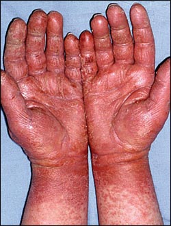 How Can You Tell if You're Allergic to Latex Gloves? – GloveNation