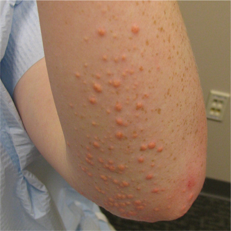 Multiple Erythematous Yellow Dome Shaped Papules Aafp