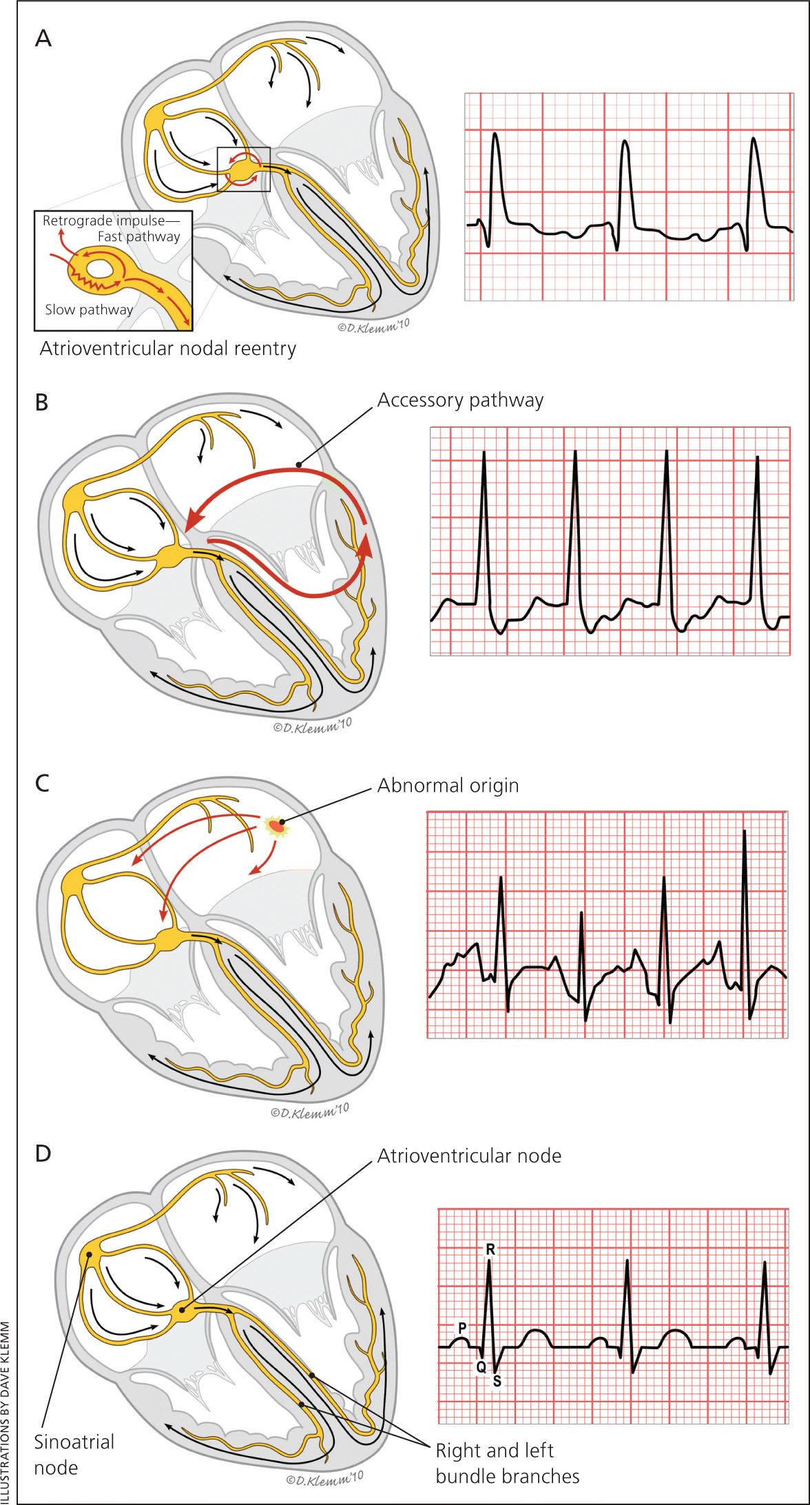 Supraventricular Tachycardia Types Medicine Question Bank