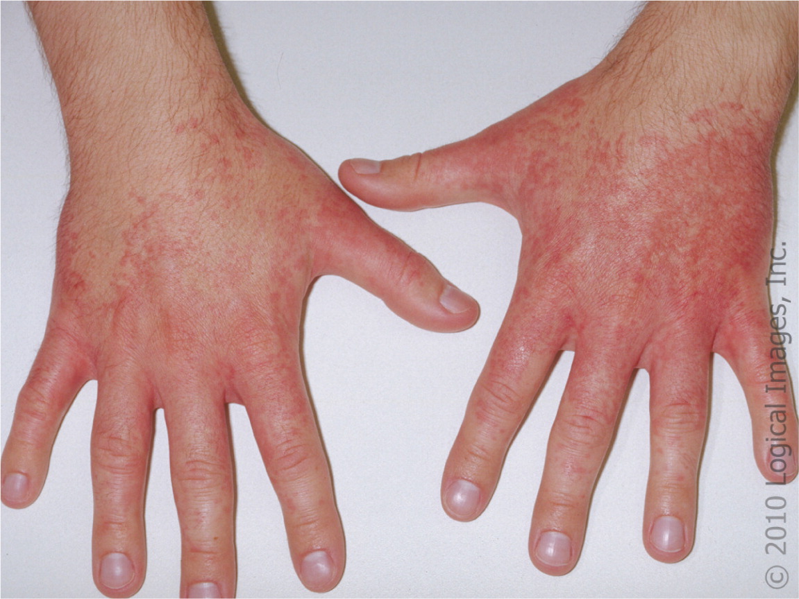 Hives On Hands