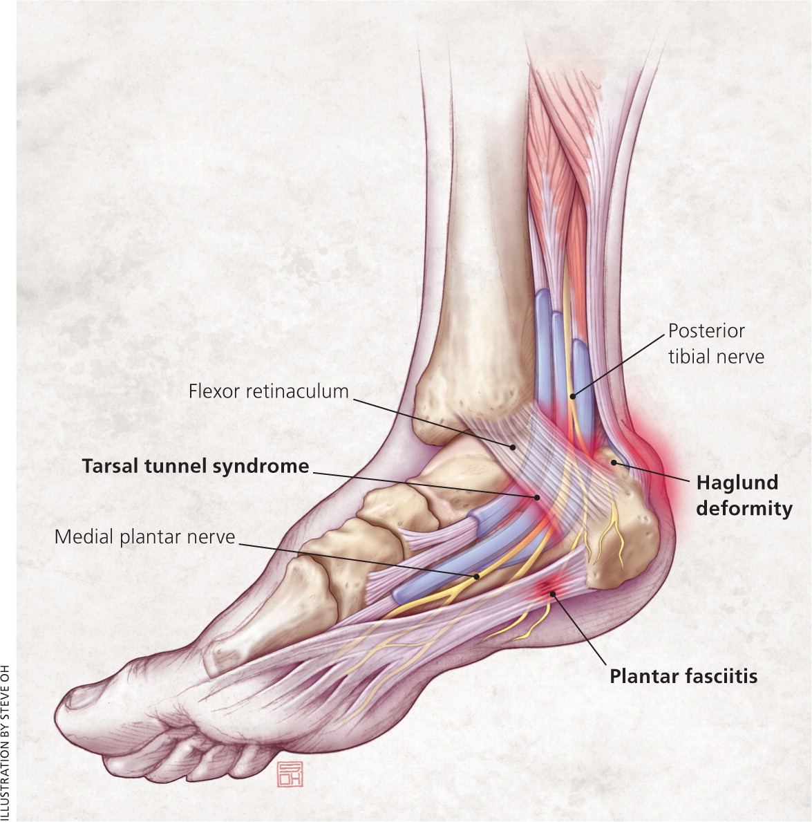 medial aspect of heel