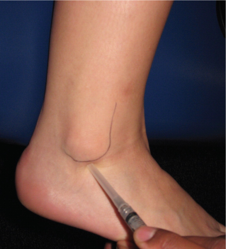 Lateral Ankle Sprain - Hersco Edu Center