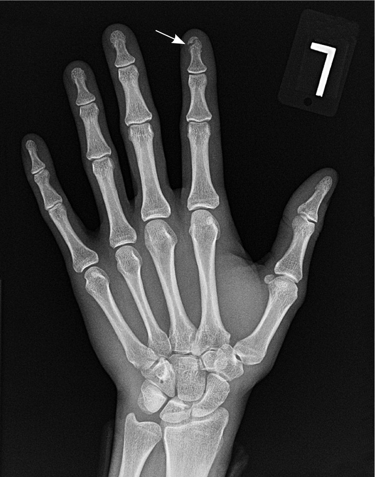 broken finger tip