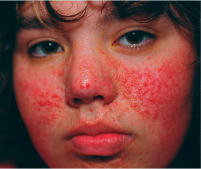 Erythematous Papules On The Face Aafp