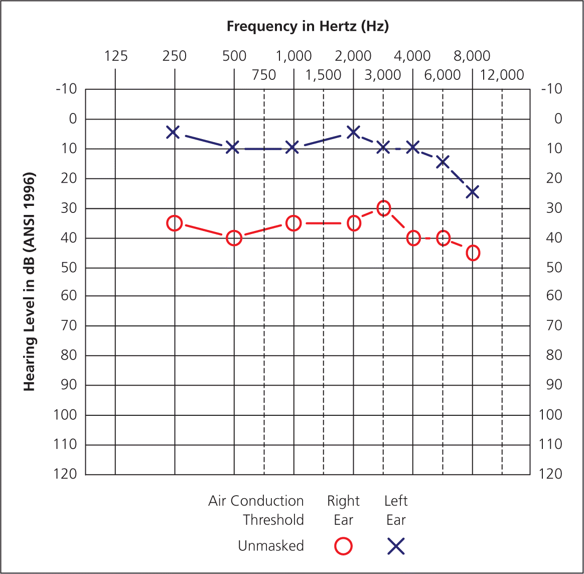 Audiometry Screening And Interpretation AAFP