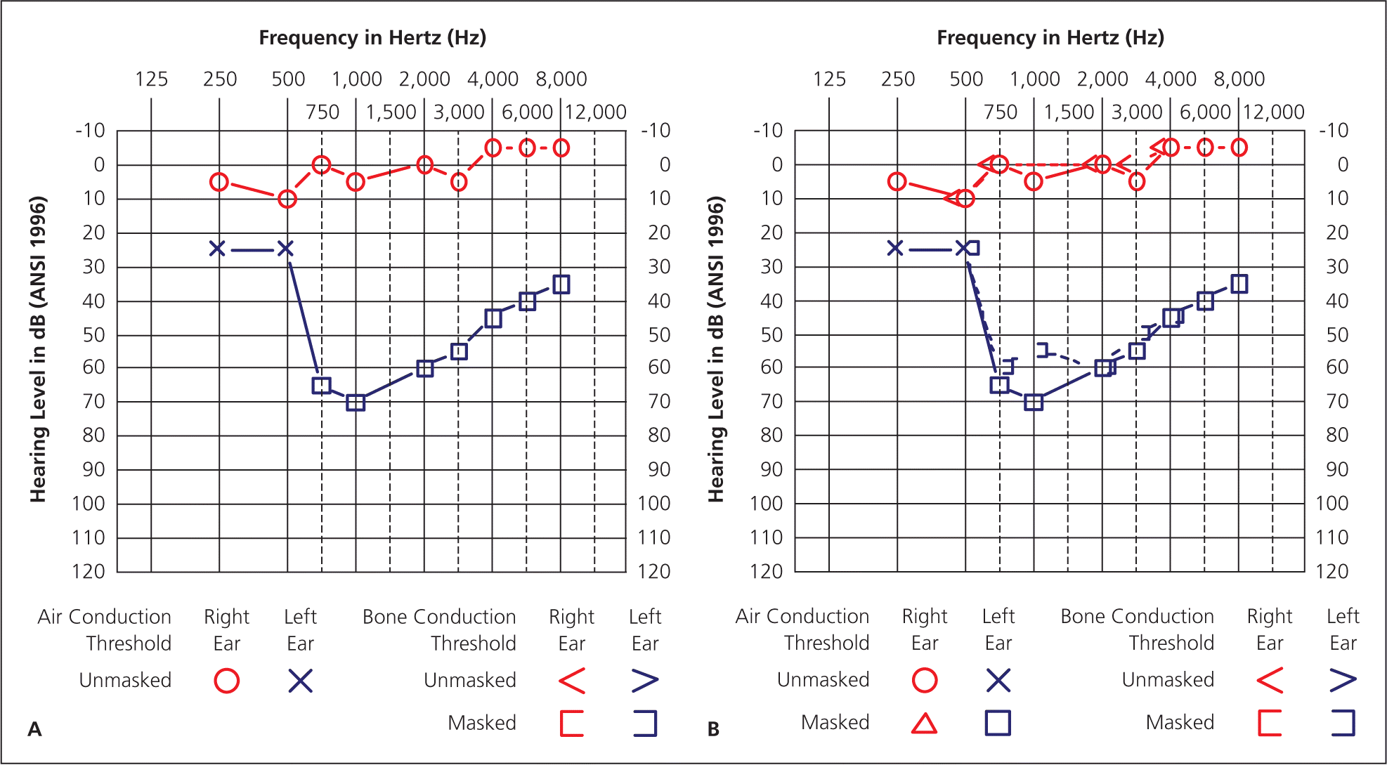 Audiometry Screening And Interpretation AAFP