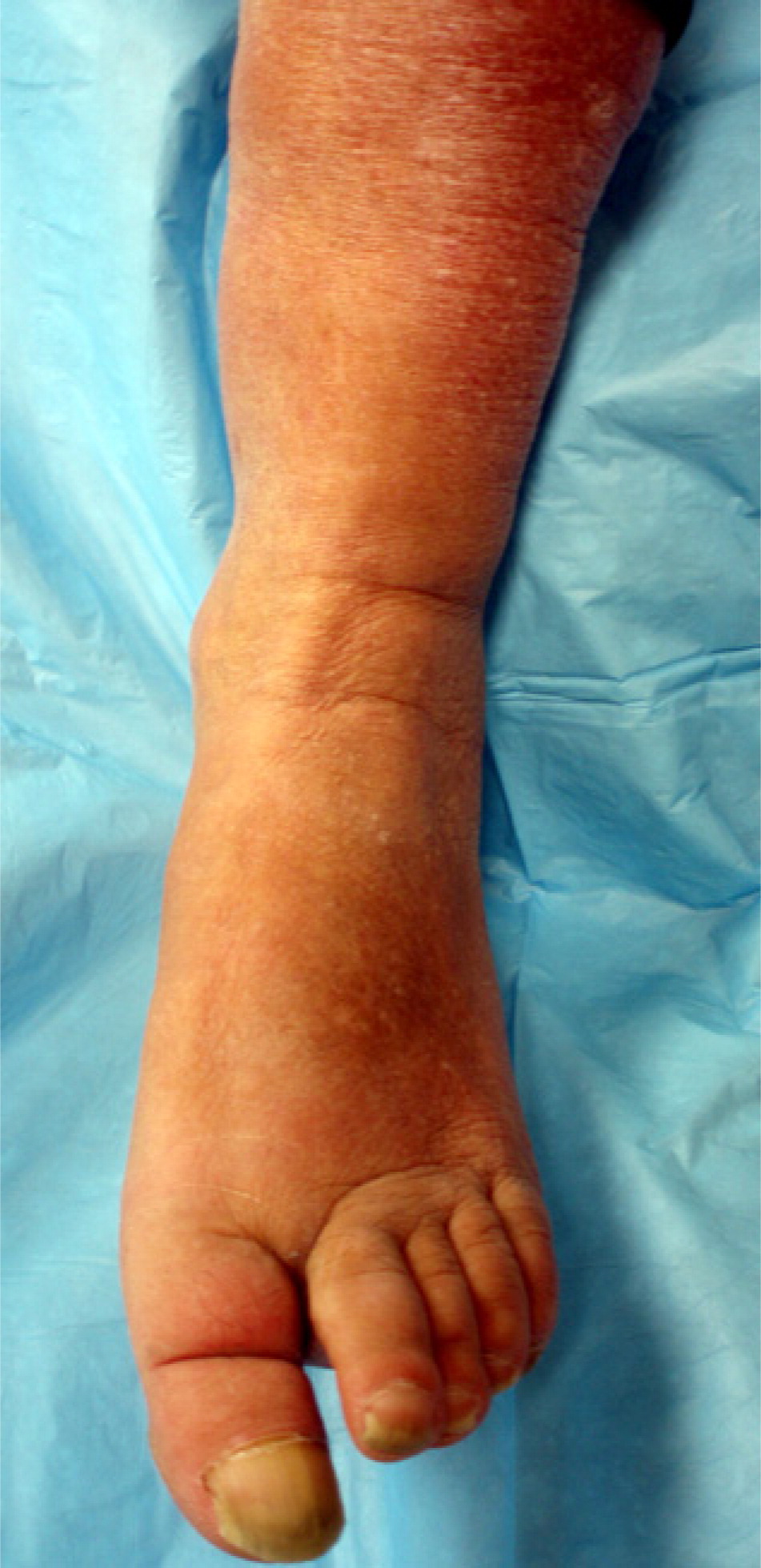 Edema Diagnosis And Management AAFP