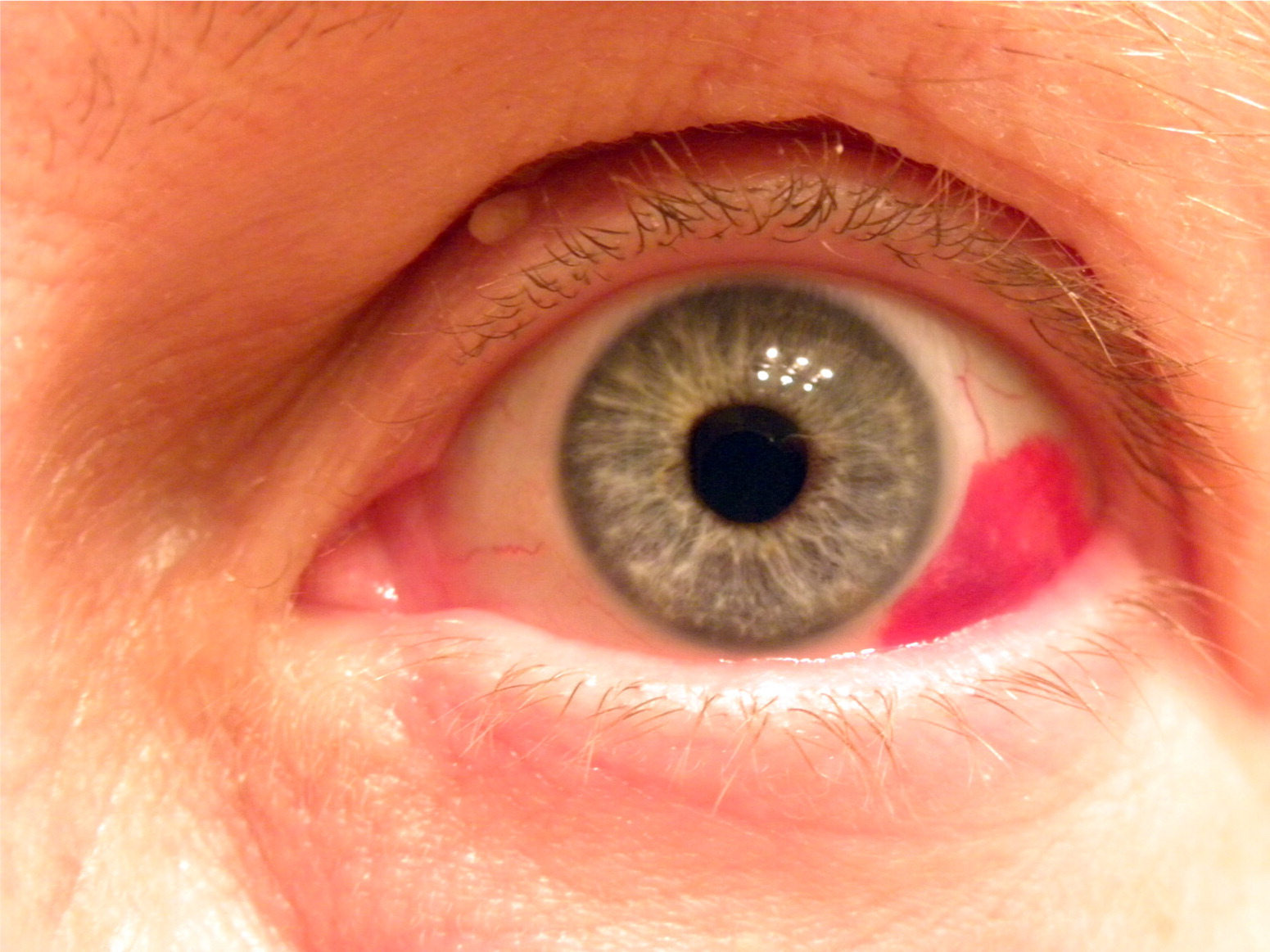 Painless Red Eye AAFP