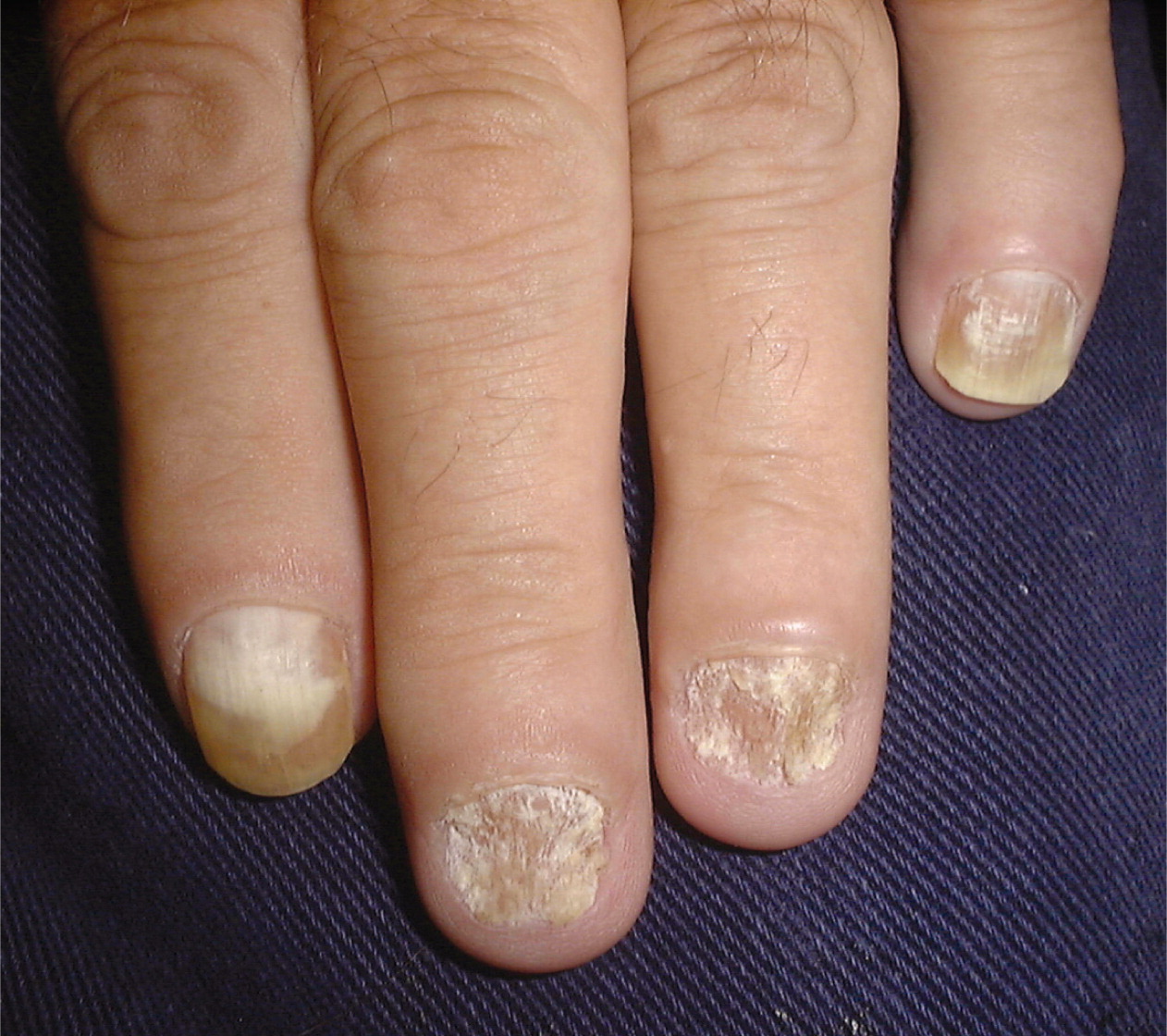 Medical Addicts - Info: Trachyonychia Trachyonychia clinically appears as  if the nails have been sandpapered in the longitudinal direction, which  leaves a rough-ridged texture. Sometimes the terms trachyonychia and 20-nail  dystrophy are