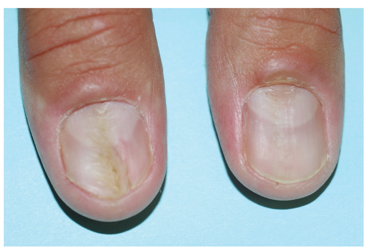 A fungal infection of the nail plate, Onychomycosis, Tinea Unguium