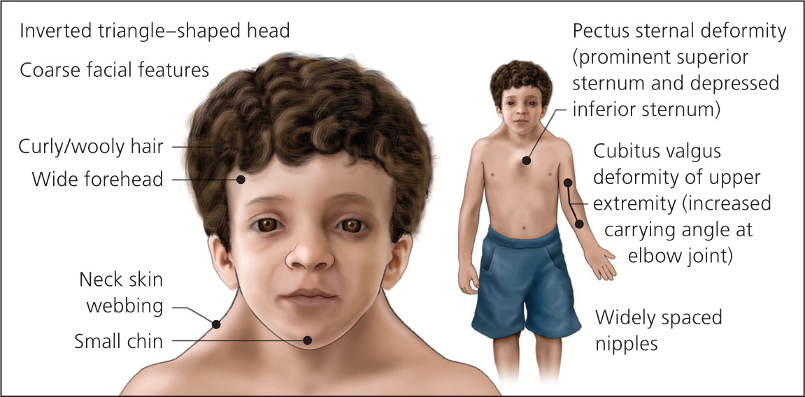 Noonan Syndrome Diagram