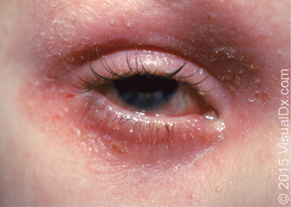 swollen eyelid