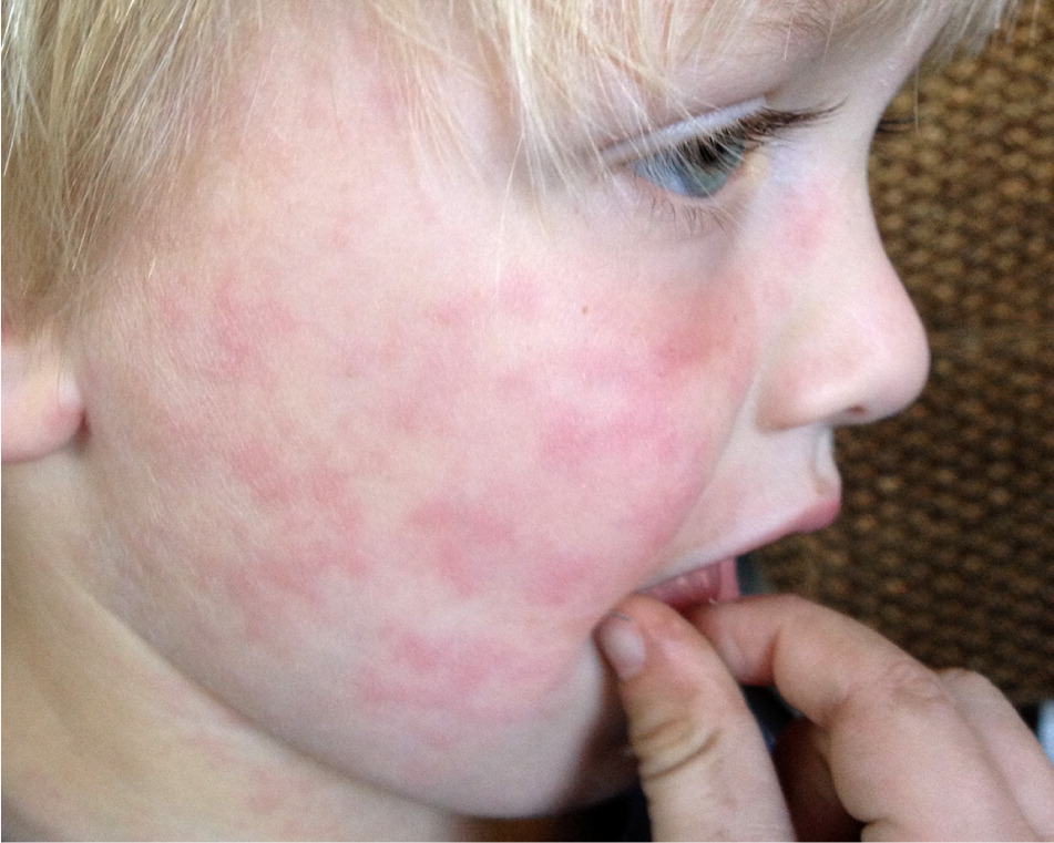 Viral Rash In Children Face