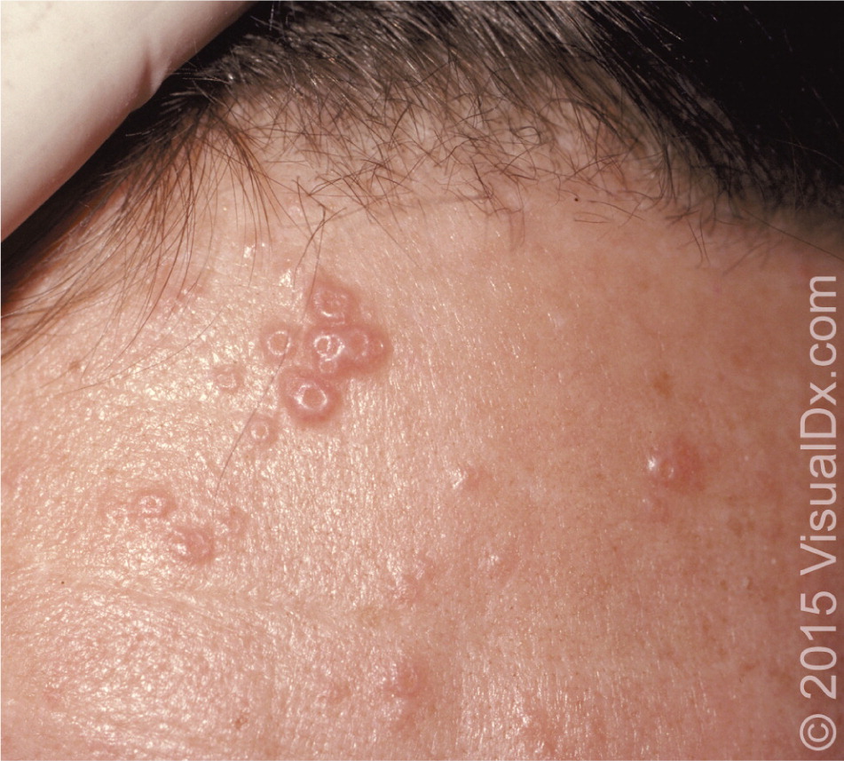 Childhood rashes, skin conditions and infections: photos