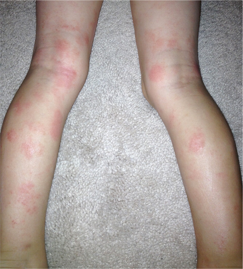 Common Skin Rashes In Children 2022 