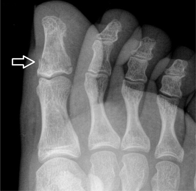 big toe stress fracture