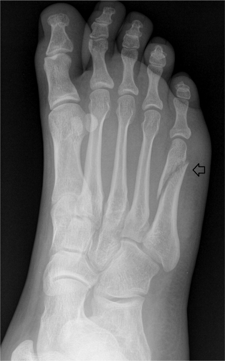 Diagnosis And Management Of Common Foot Fractures Hot Sex Picture