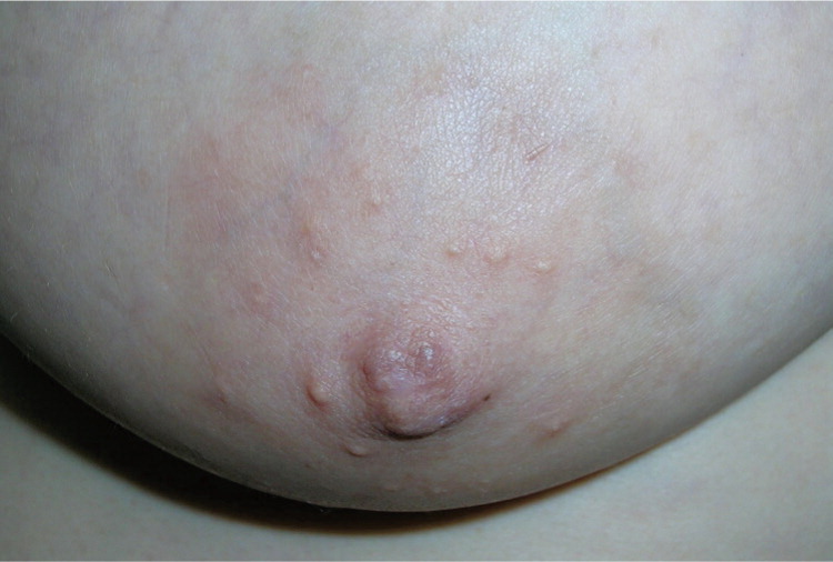 Pruritic Nodules on the Breast