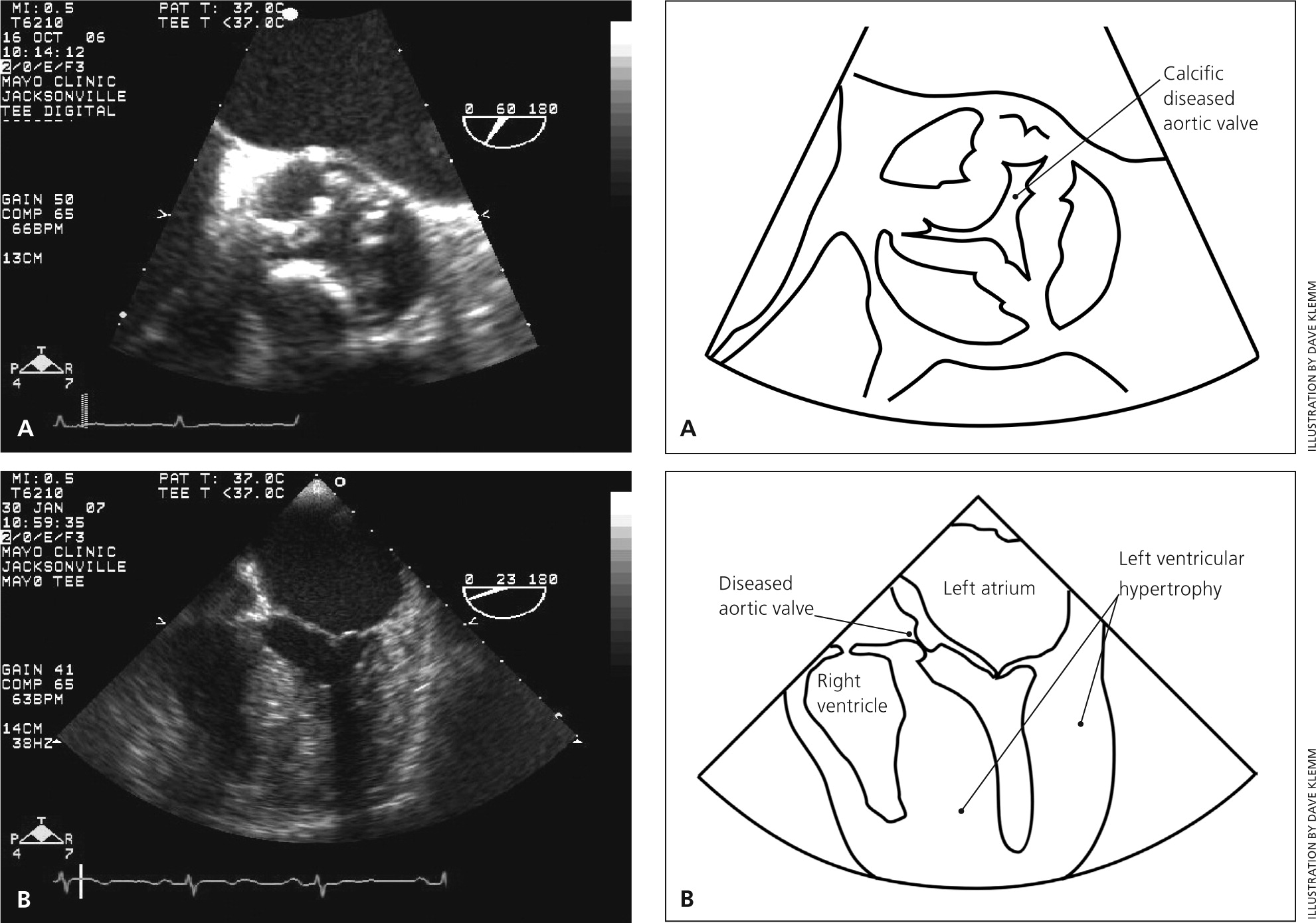 Aortic Stenosis Diagnosis And Treatment AAFP