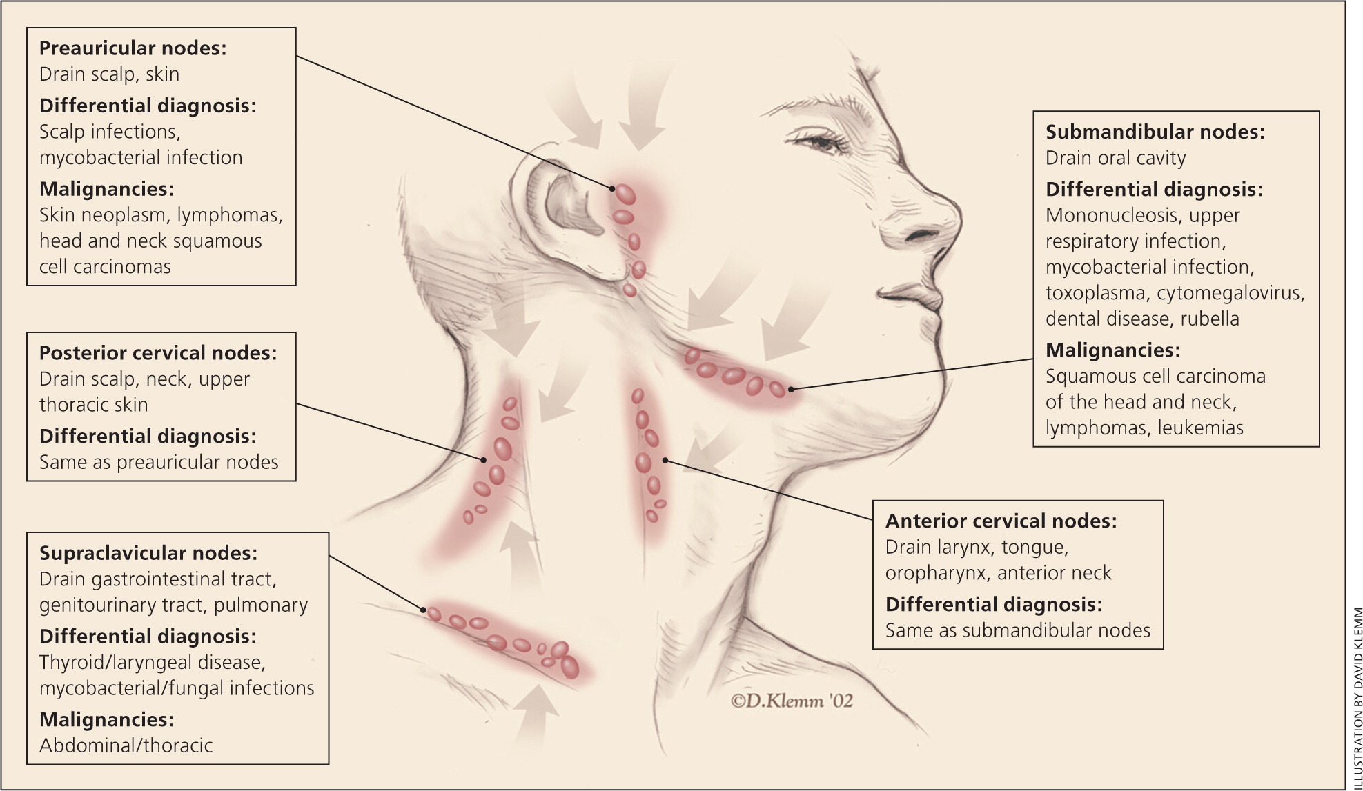 Unexplained Lymphadenopathy Evaluation And Differential Diagnosis AAFP