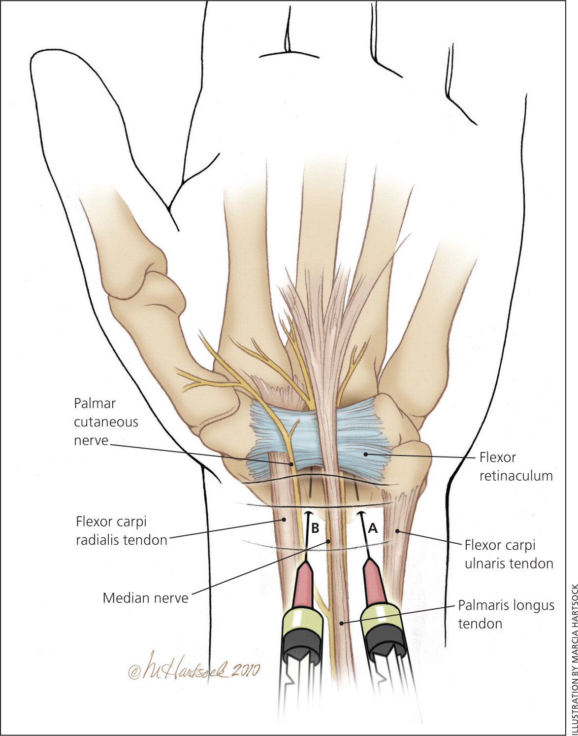 Understanding Carpal Tunnel Syndrome 