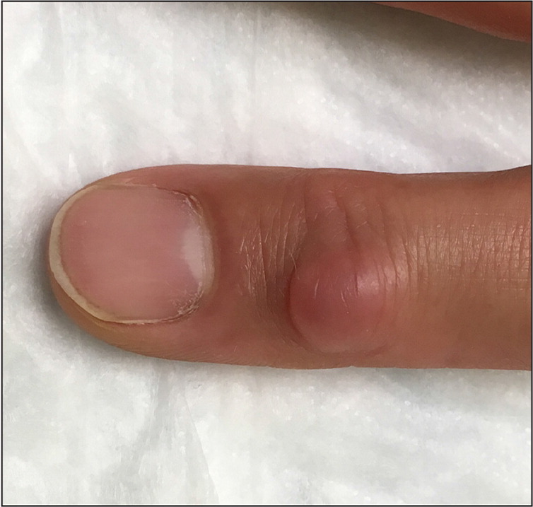 Dome-Shaped Lesion on the Finger | AAFP