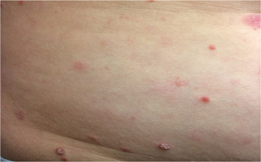 Pityriasis Rosea Condition, Treatments and Pictures for Teens