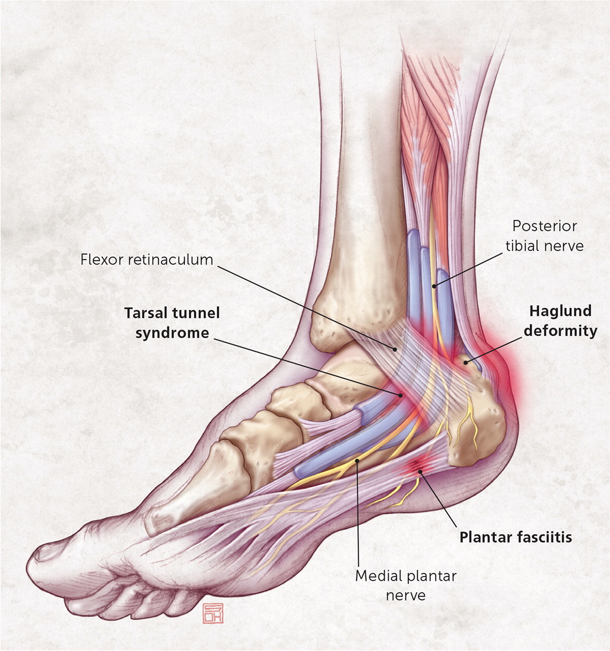 Heel pain known as 'Sever's disease' frequently affects young athletes