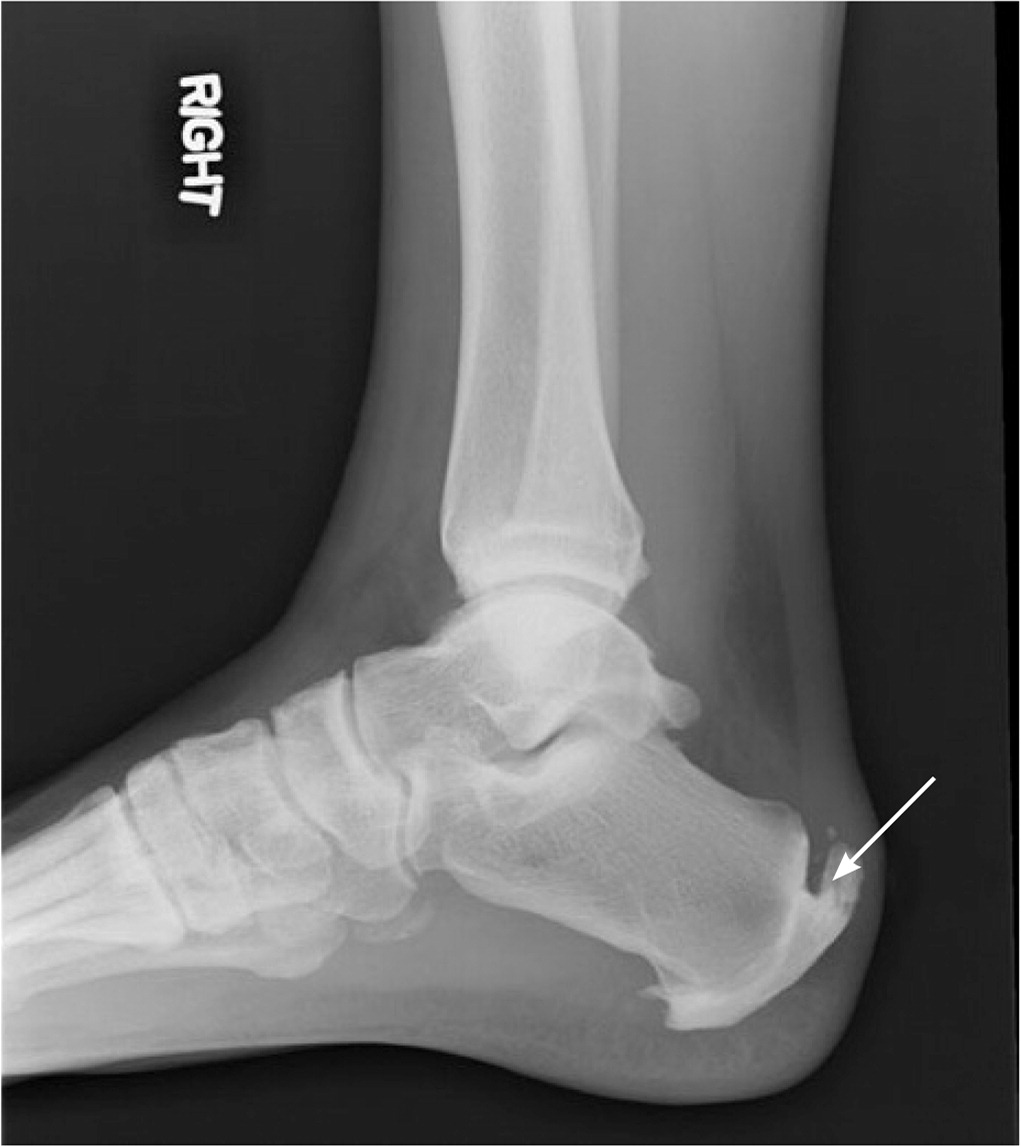 Trail Effect: The curse of pointy heels: Modifying shoes for Haglund's  deformity