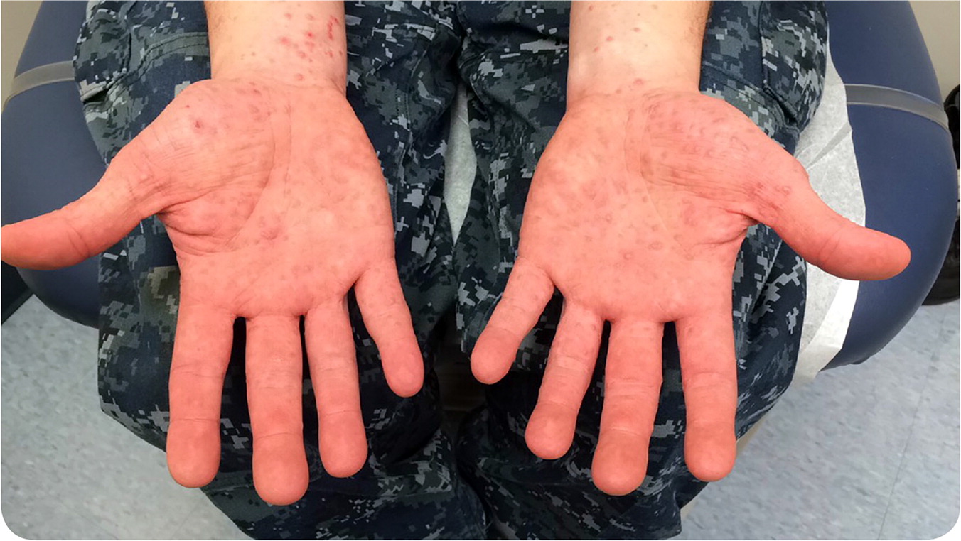 Progressive Rash Involving The Hands And Feet AAFP