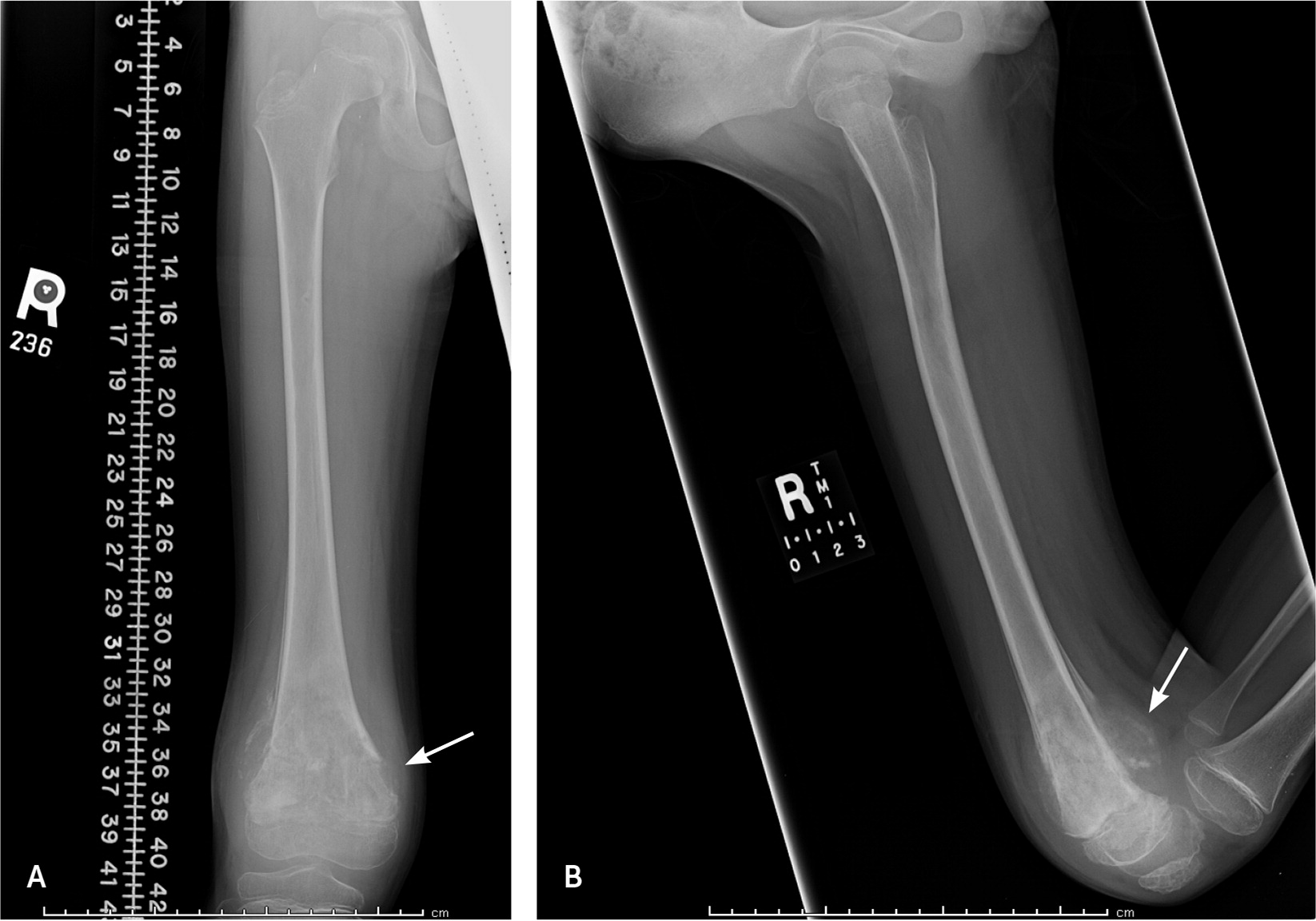 Bone Cancer Diagnosis And Treatment Principles AAFP