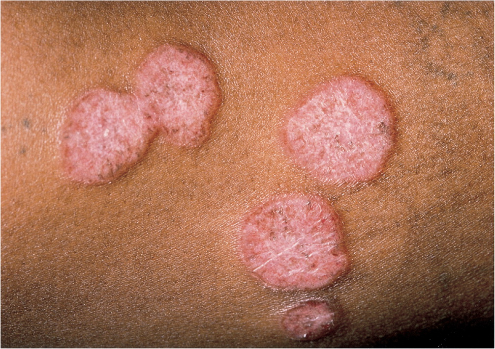 Multiple pruritic, annular plaques, characteristic of tinea corporis