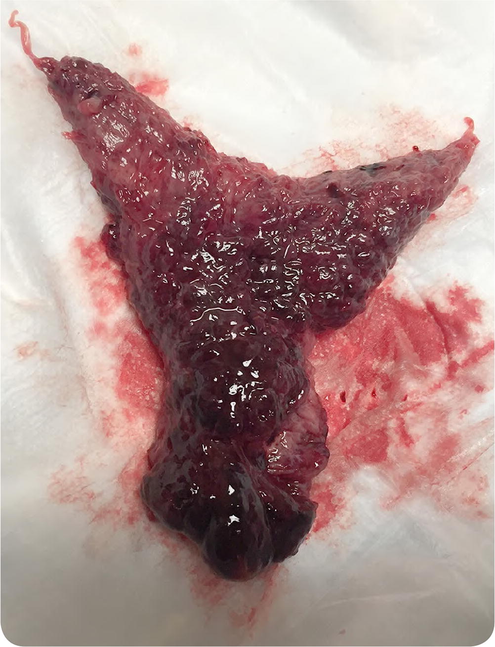 The tissue from Case 1, open and showing blood clots and endometrium