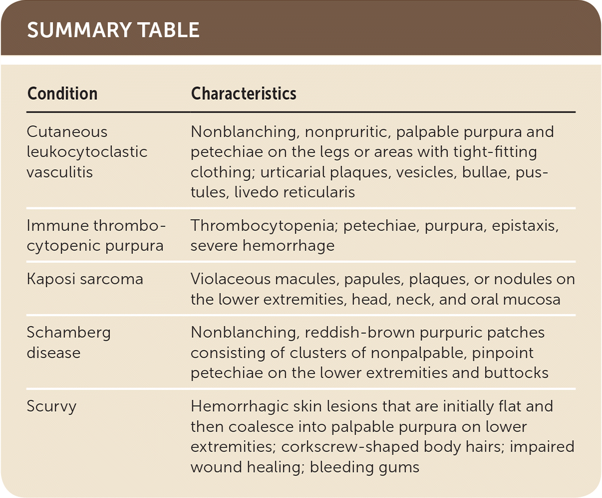 Abrupt Rash With Painful Nonpruritic Purpura On The Lower Extremities 