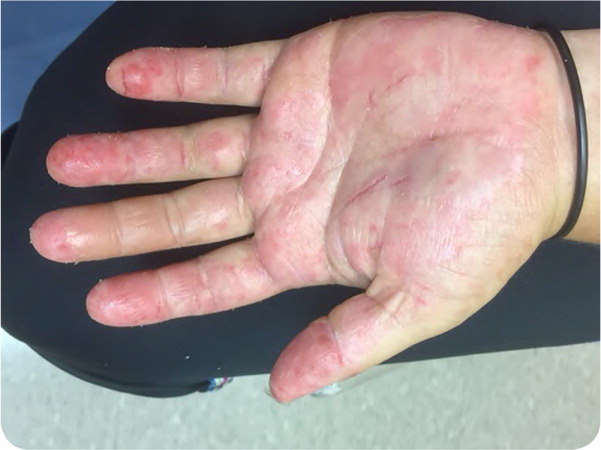 maculopapular rash hands