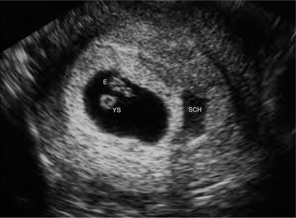 threatened miscarriage case study
