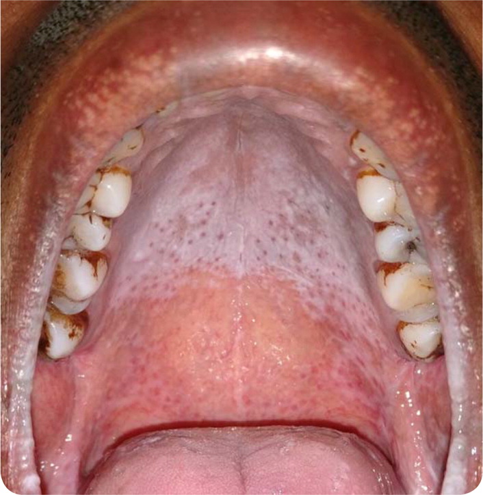roof of mouth white