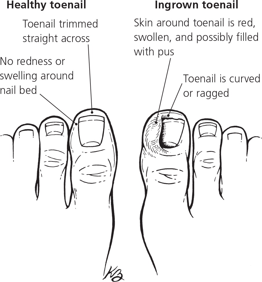 Ingrown Toenails AAFP