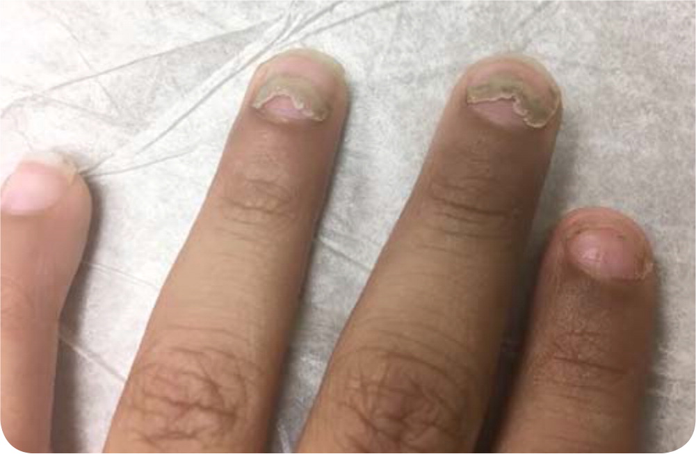 My nail cracked in the middle. What should I do? - Quora