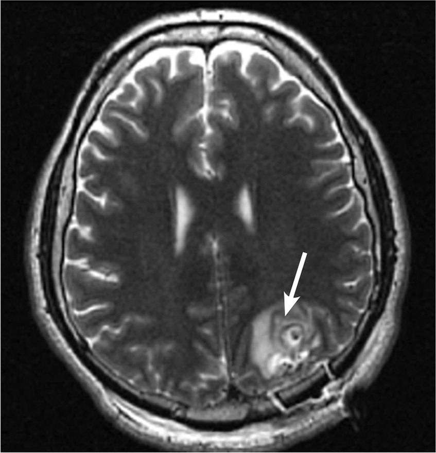 Seizure With Brain Lesions AAFP